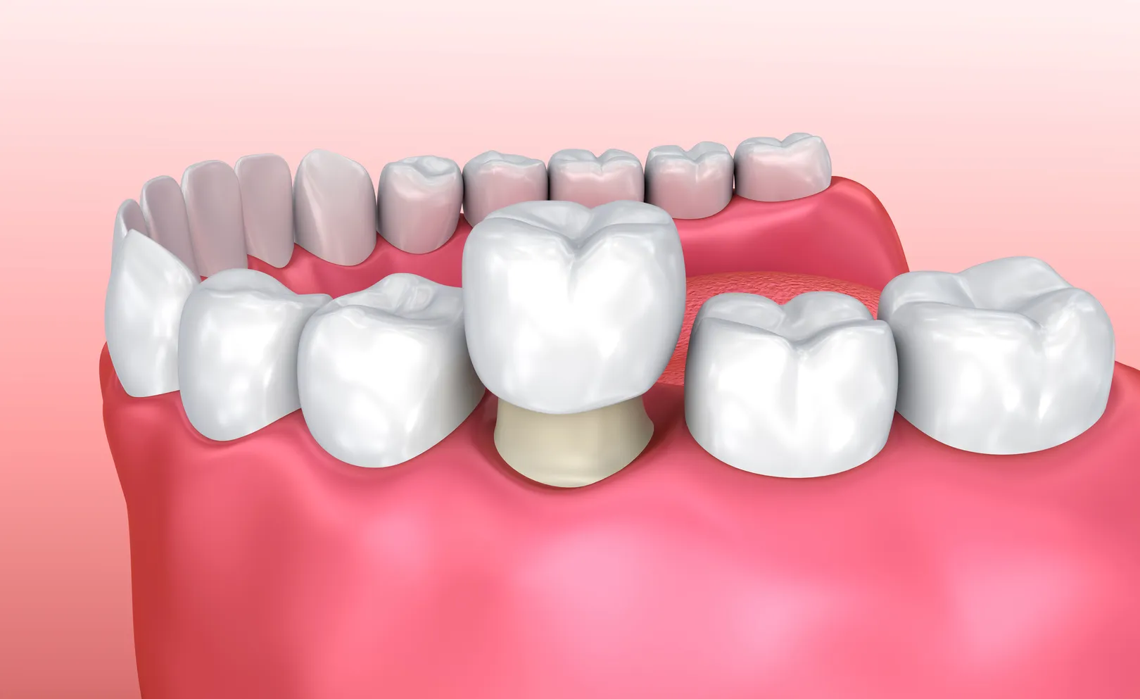 Clear Aligners