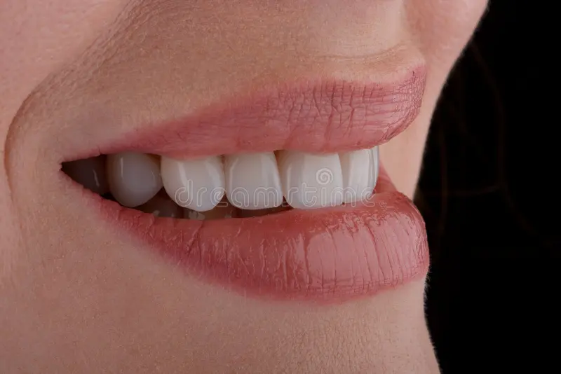 Clear Aligners