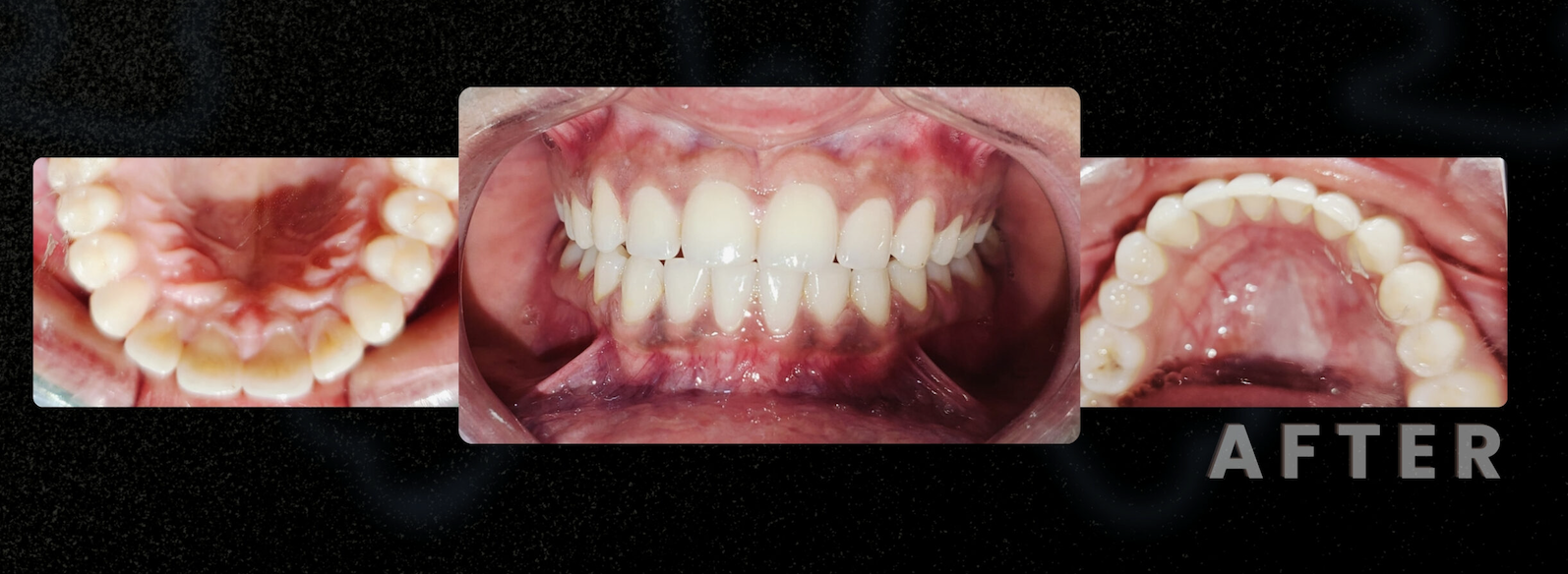 After — Clear Aligner
