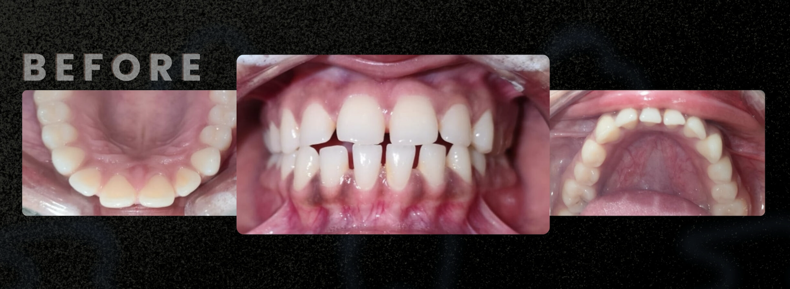 Before — Clear Aligner