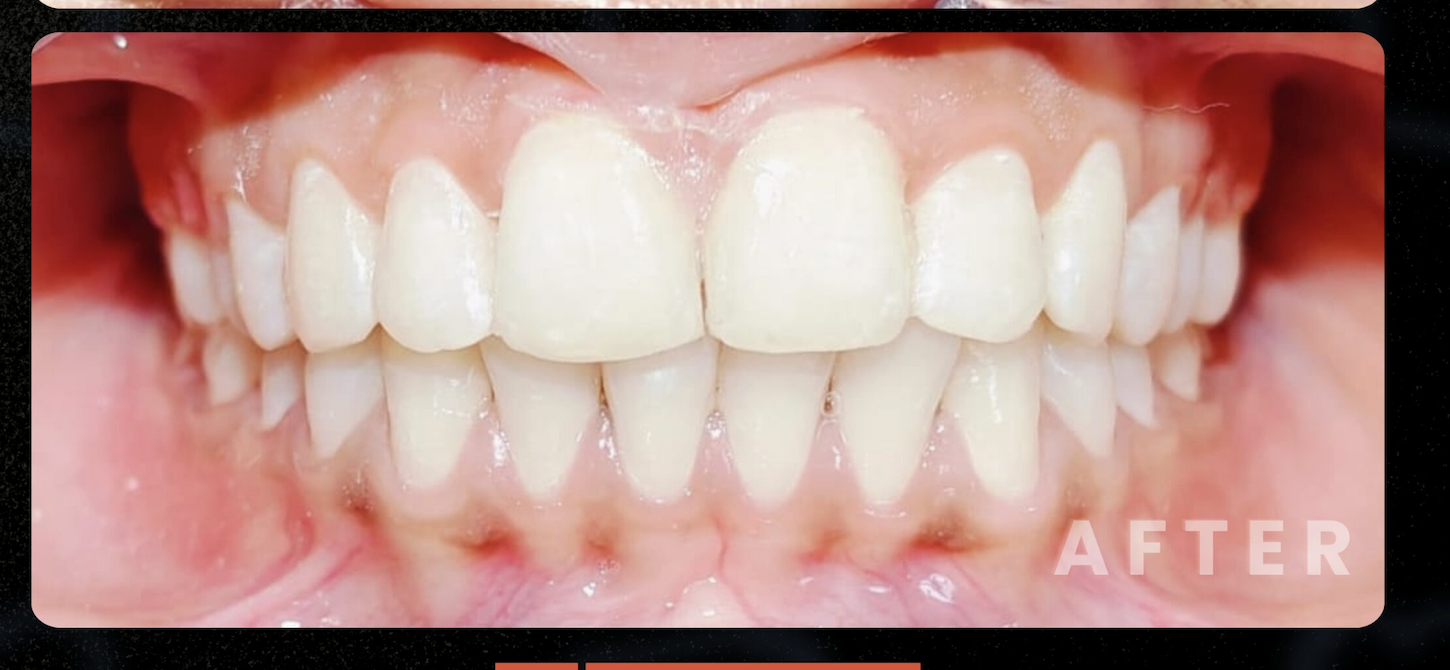 After — Smile Makeover