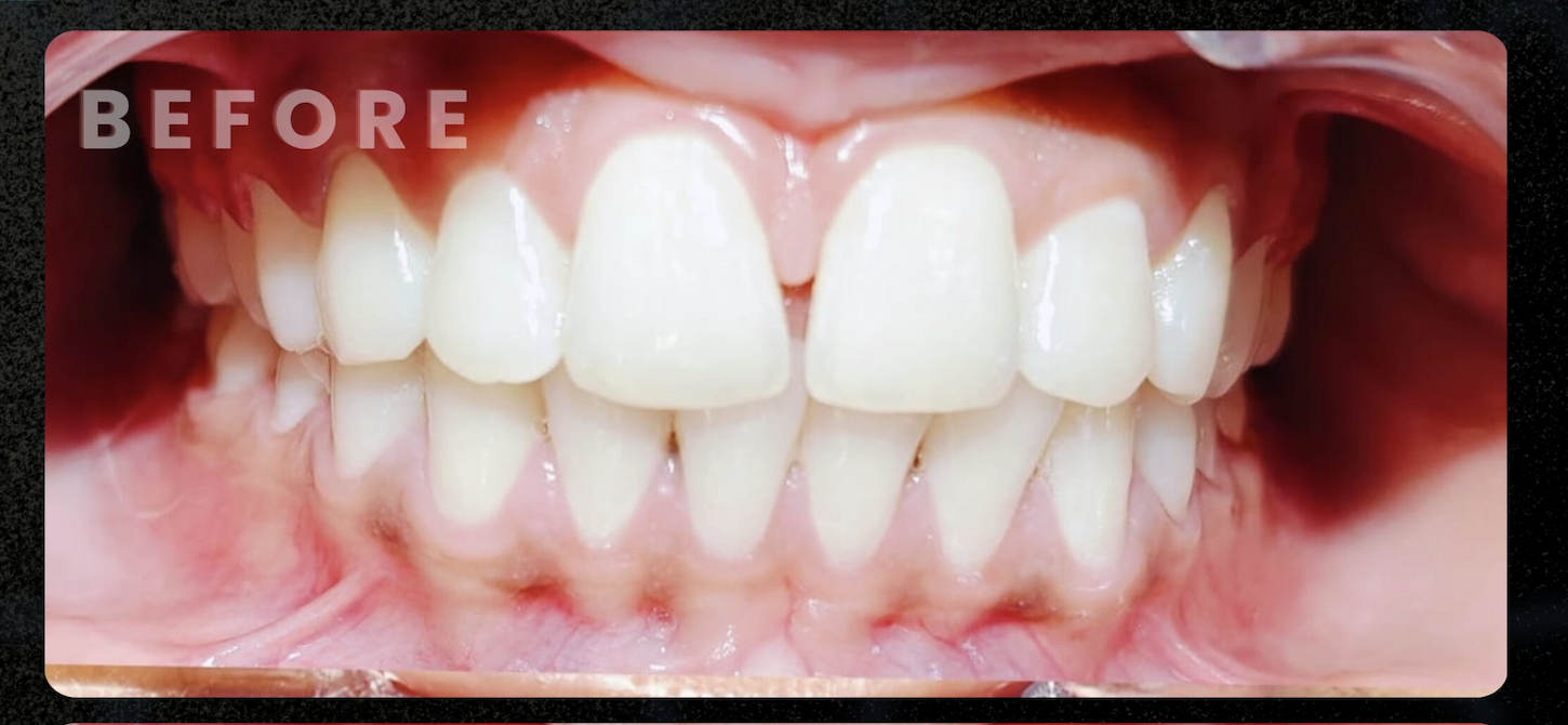 Before — Smile Makeover