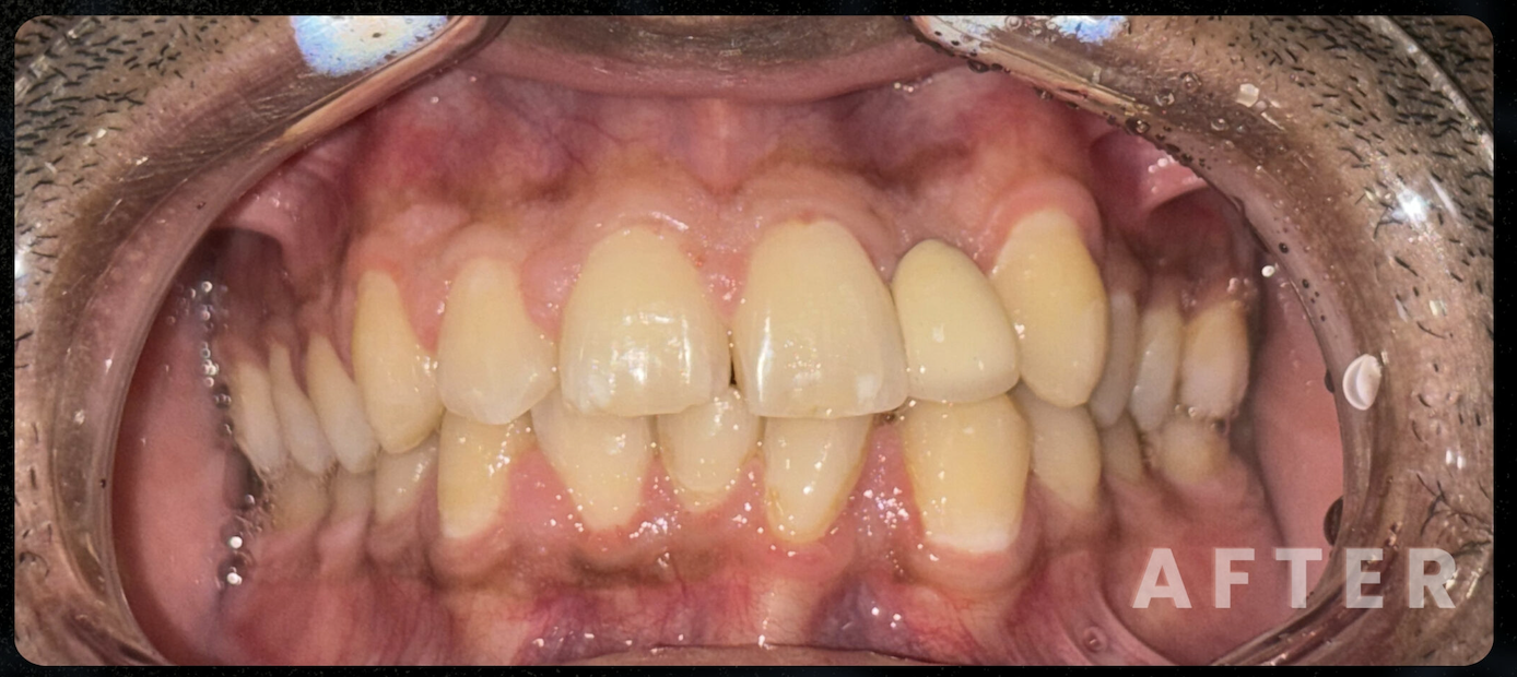 After — Dental Implant