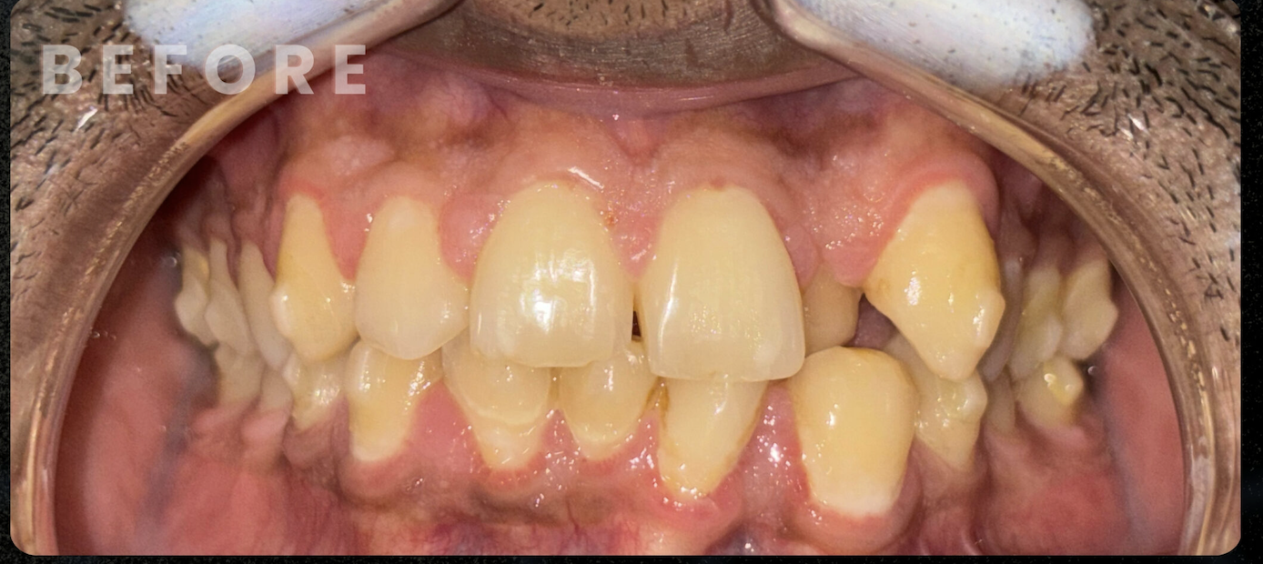 Before — Dental Implant